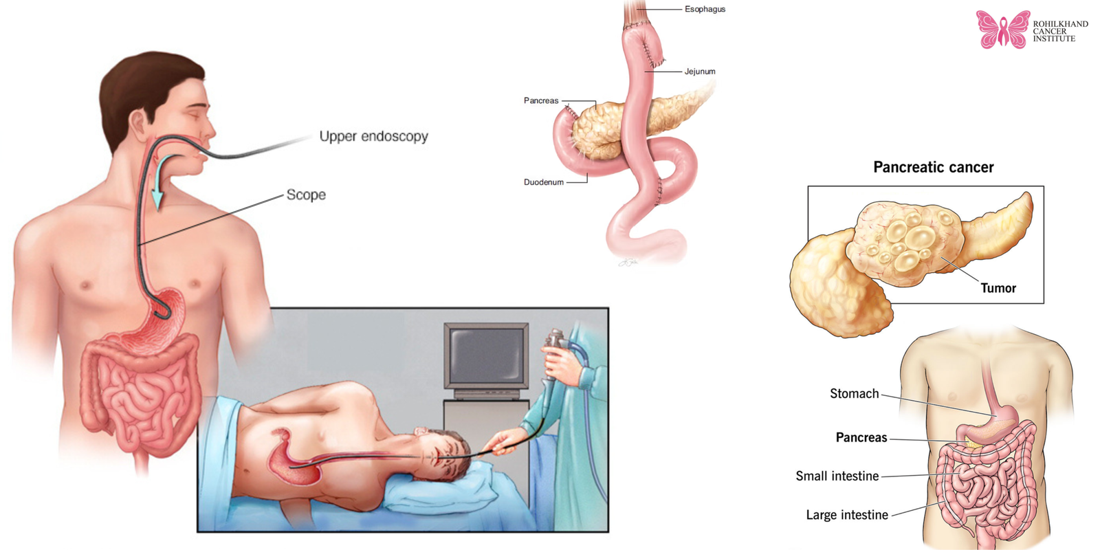 Stomach Cancer Care Uttar Pradesh – Expert Treatment at Rohilkhand Cancer Institute