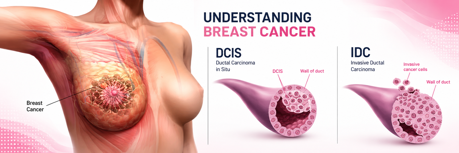 Breast Cancer Treatment in Bhojipura, Uttar Pradesh | Expert Care at Rohilkhand Cancer Institute