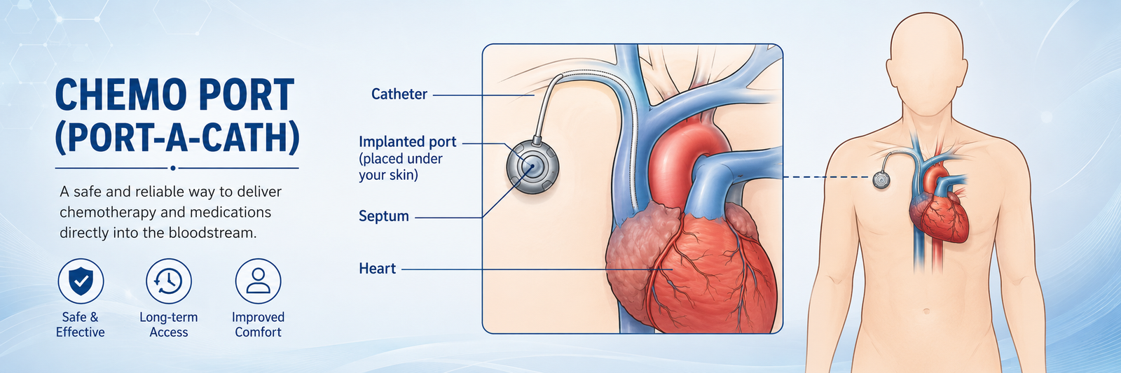 Chemo Port Insertion and Care in Bhojipura, Uttar Pradesh | Rohilkhand Cancer Institute